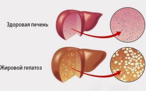 Как лечить жировой гепатоз
