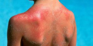 Развитие рака кожи: симптомы