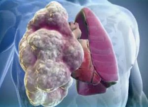 Рак легких 2 стадия: симптомы и лечение