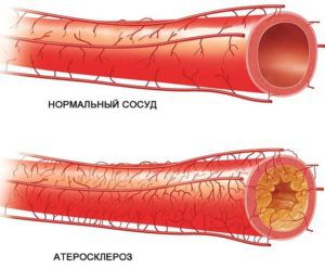 Атеросклероз нижних конечностей и банные процедуры