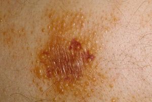 Амилоидоз кожи лечение и симптомы