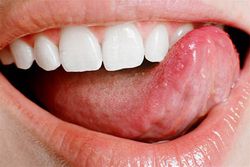 Рак языка: симптомы и лечение