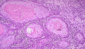 Плоскоклеточный рак шейки матки