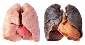 Сколько нужно курить, чтобы получить рак легких 