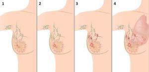 Как определить рак груди