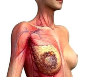 Метастазы при раке молочной железы
