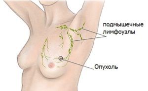 Как определить рак груди