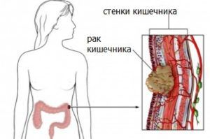 Диагностика рака кишечника