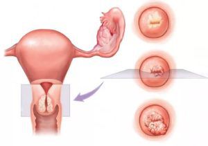 Рак шейки матки и беременность