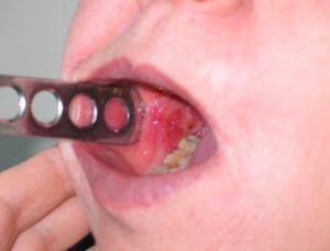 Рак слизистой оболочки рта