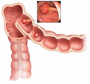 Тубулярно-ворсинчатая аденома толстой кишки