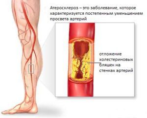 Лечение атеросклероза нижних конечностей – лекарства