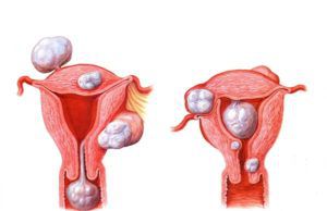 Фибромиома матки. Лечение народными средствами