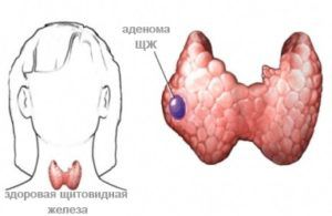 Доброкачественная опухоль щитовидной железы