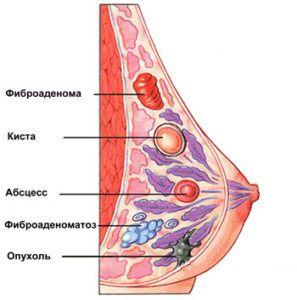 Фиброма молочной железы