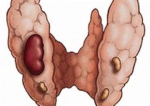 Фолликулярная аденома щитовидной железы