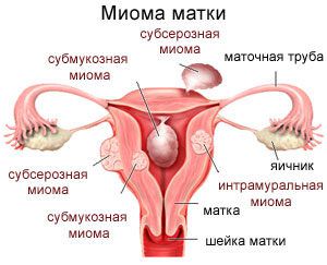 Методы лечения миомы матки