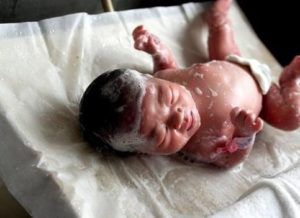 Стеноз аорты у новорожденных