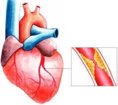 Профилактика инфаркта миокарда