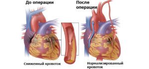 Что такое шунтирование сердца после инфаркта