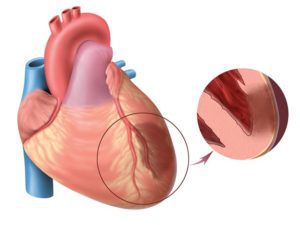 Абдоминальная форма инфаркта миокарда 