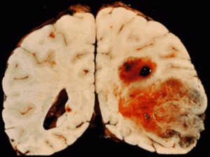 Глиома головного мозга – что это такое?