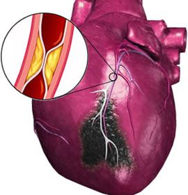 Субэндокардиальный инфаркт миокарда