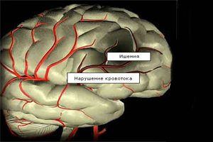 Ишемия головного мозга - лечение народными средствами