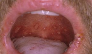 Сифилис во рту