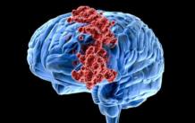 Рак головного мозга: причины, стадии, симптомы