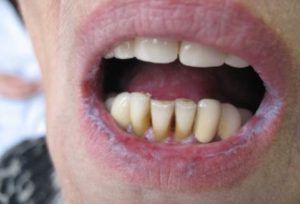 Рак губы: симптомы и признаки
