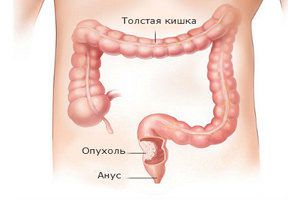 Рак кишечника - лечение и симптомы