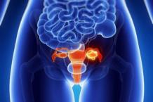 Диагностика и стадии рака яичников у женщин