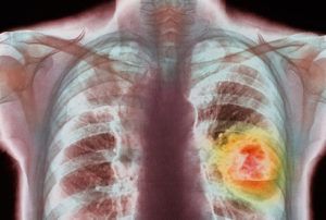 Рак легких: способы лечения