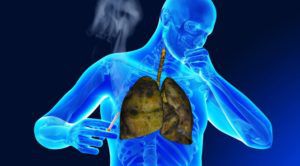 Рак легких: способы лечения