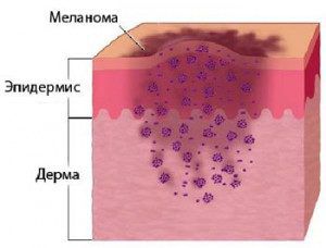 Меланома 4 стадия продолжительность жизни