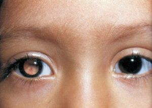 Рак глаза и симптомы
