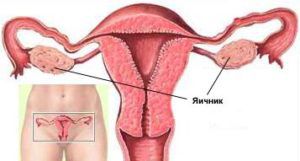 Рак матки 3 стадия