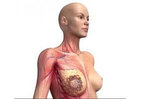 Рак молочной железы - продолжительность жизни