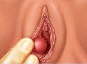 Рак половых губ: лечение