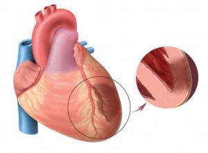 Что такое обширный инфаркт?