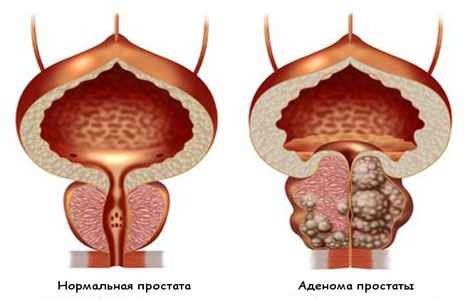 Что такое аденома простаты как лечить