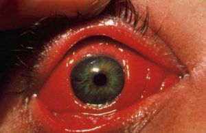 Хламидийная инфекция глаз