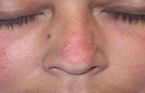 Сифилис носа