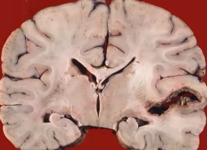 Абсцесс головного мозга - симптомы, лечение