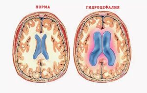 Смешанная гидроцефалия головного мозга: причины