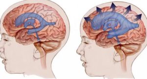 Гидроцефалия головного мозга - симптомы и причины