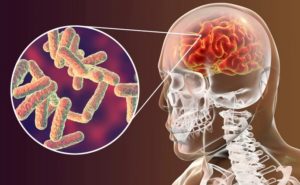 Туберкулез мозга: симптомы и лечение