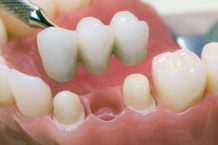 Имплантация зубов. Способ обрести красивую улыбку