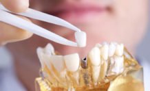 Имплантация или протезирование? Как лучше восстановить отсутствующие зубы